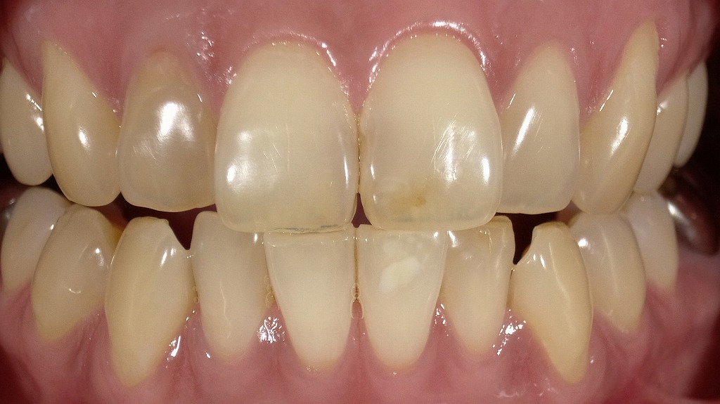 1枚目：ホワイトニング前