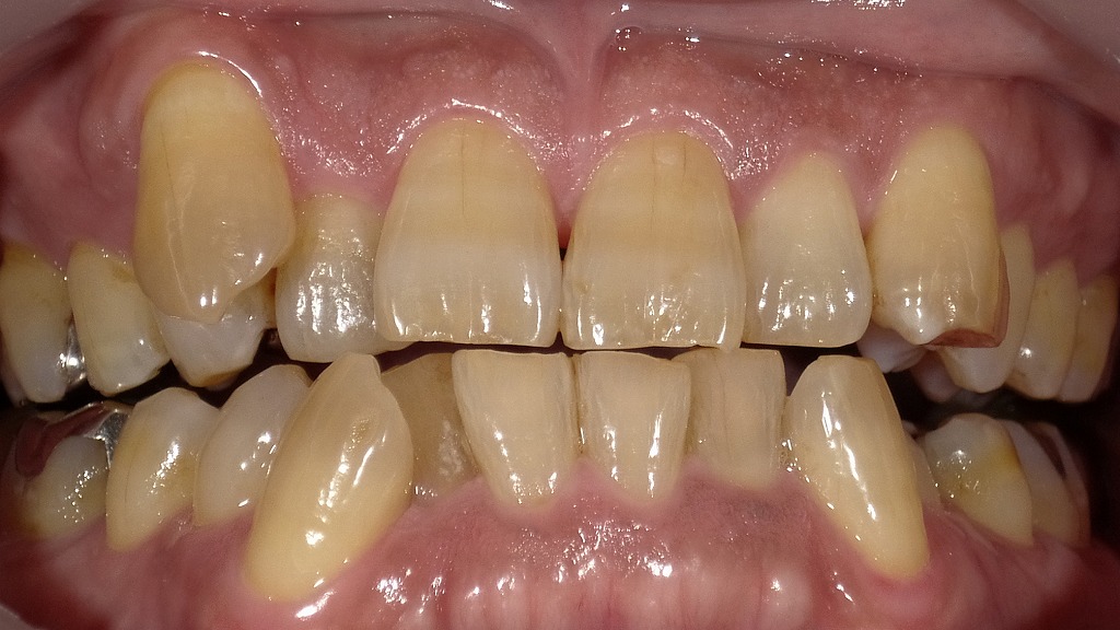 1枚目：ホワイトニング前の歯