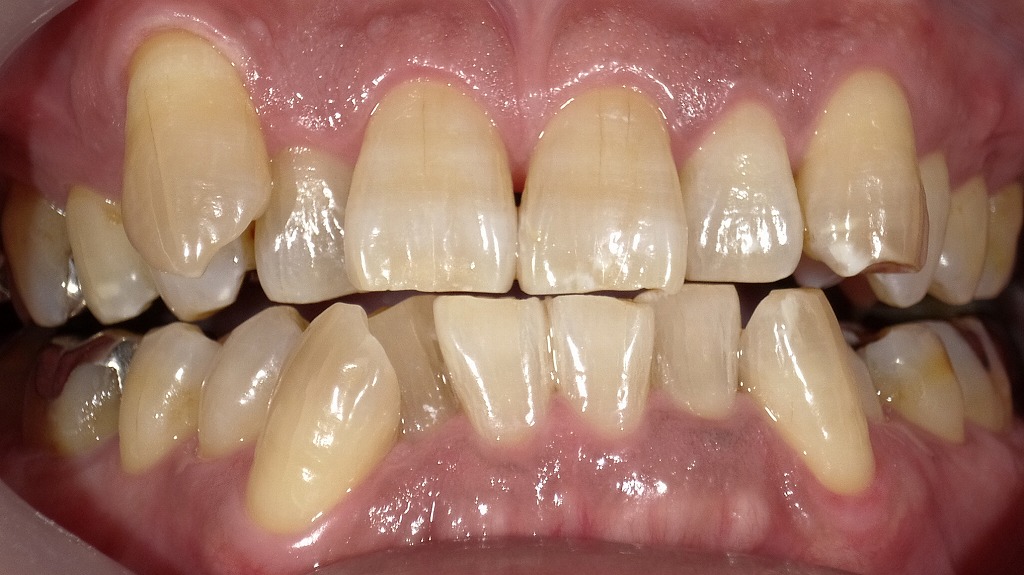 2枚目：ホワイトニング後の歯