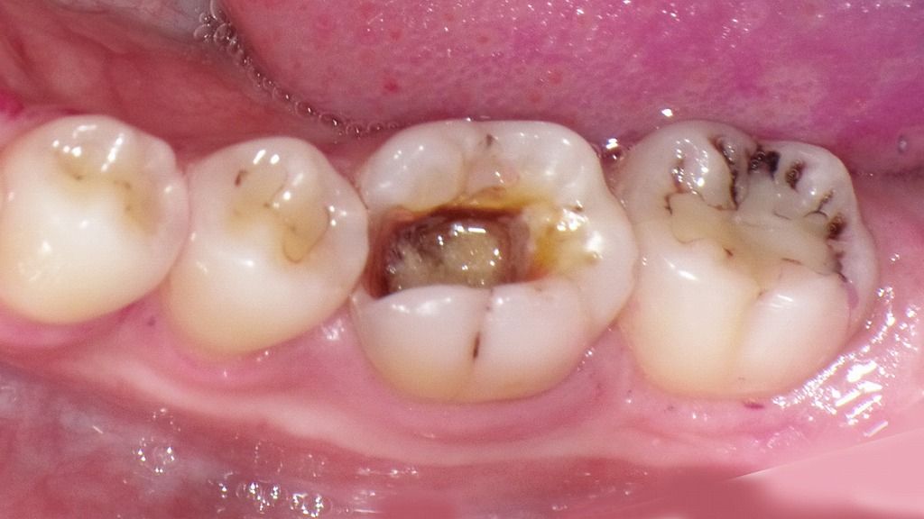 下顎左側の6番に食べ物が詰まる症例
