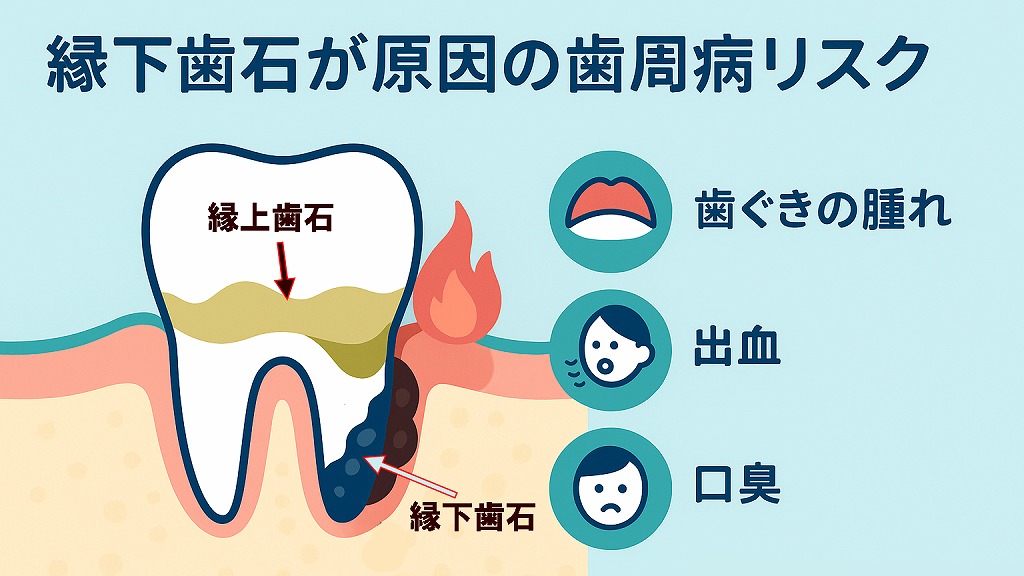  縁下歯石が原因の歯周病リスク