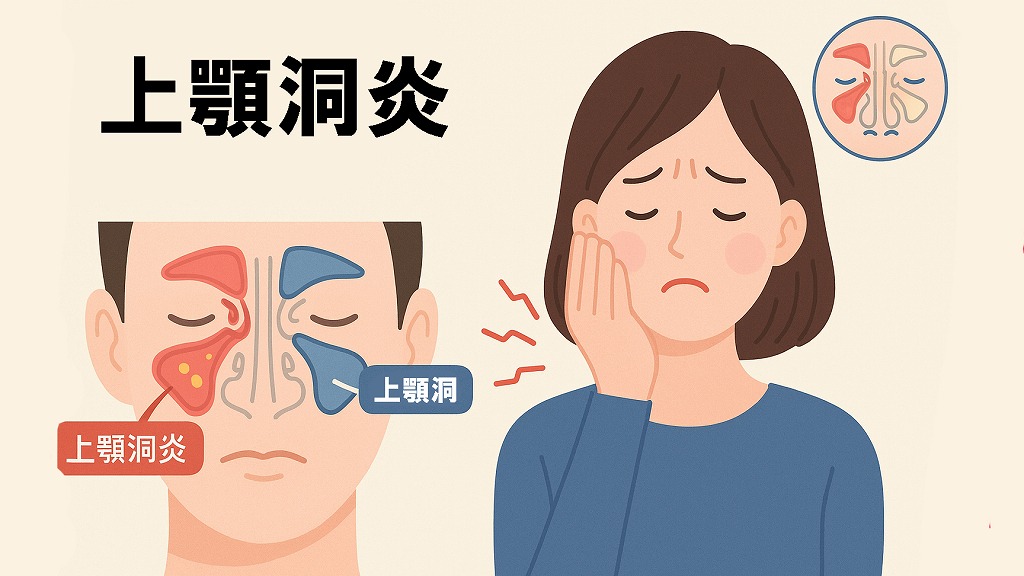 上顎洞炎