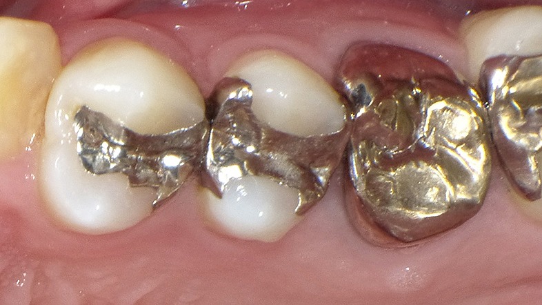 治療後に銀歯がしみる理由とは?