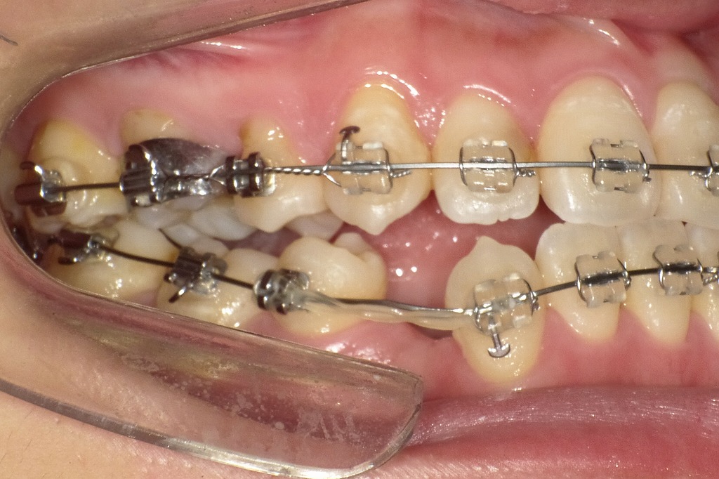 叢生改善のための上下4番抜歯とパワーチェーンを用いた矯正治療
