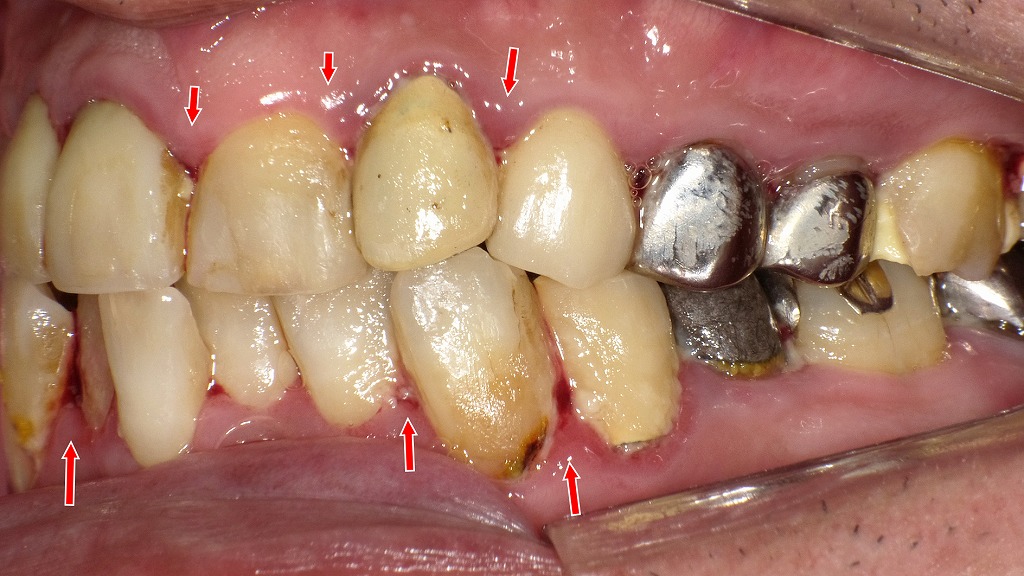 赤矢印の部位は歯周病で歯ぐきが腫れ、自然に出血している部分です。
