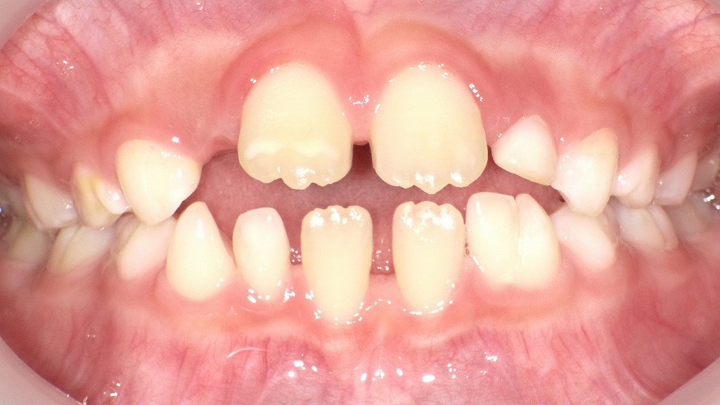 子どものオープンバイト（開咬）