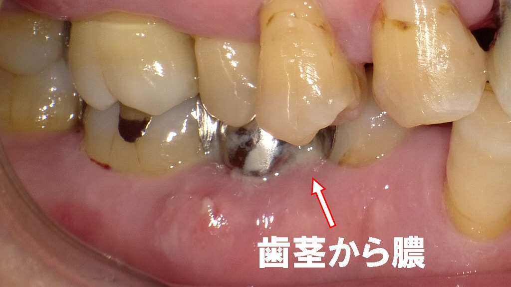 歯周病が原因で歯茎から膿がでる症例