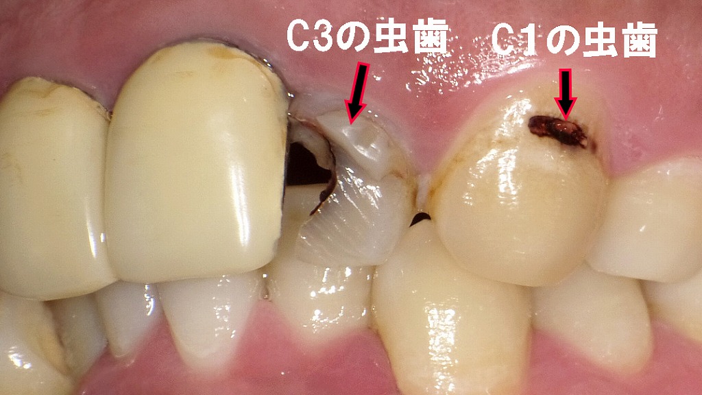 前歯の虫歯の症例３
