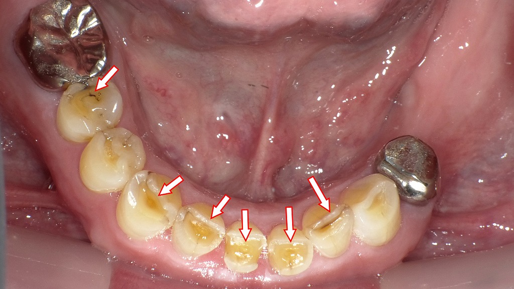 重度咬耗症の症例