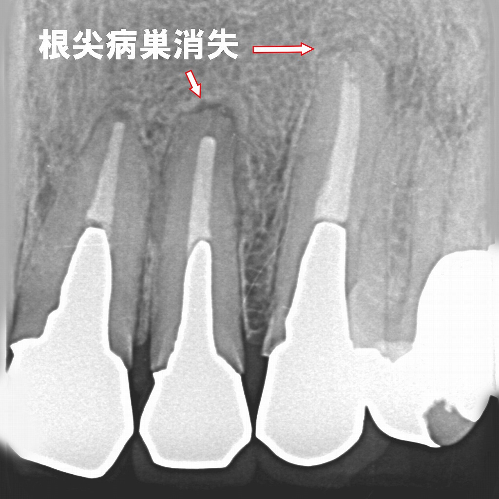 再根管治療後に根尖病巣が治癒