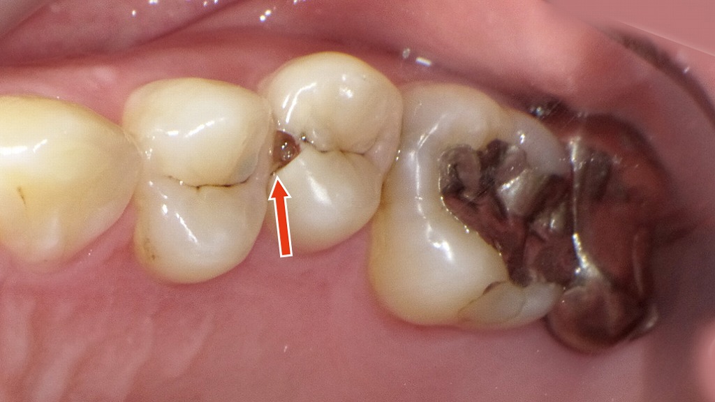 歯並びや噛み合わせの影響