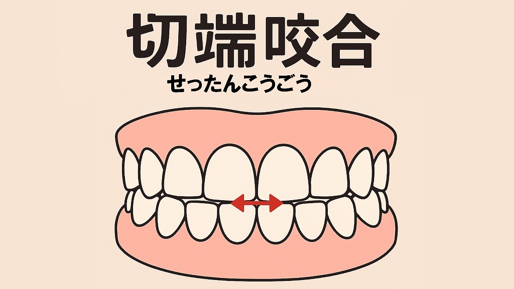 切端咬合