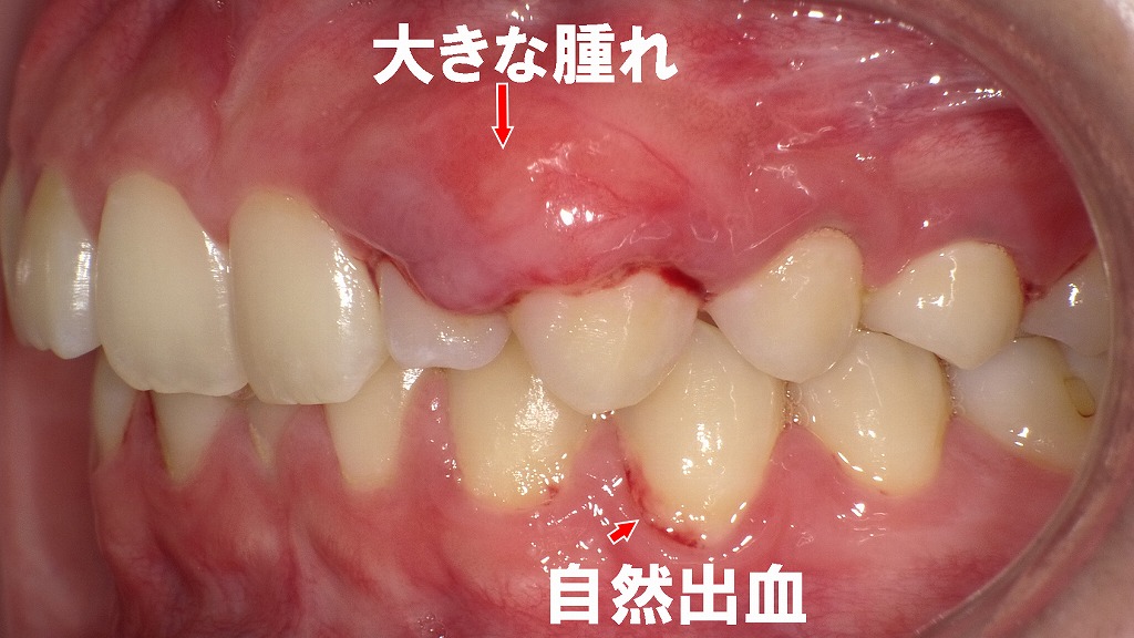 腫れの広がりと“自然出血”が見られる進行した炎症像
