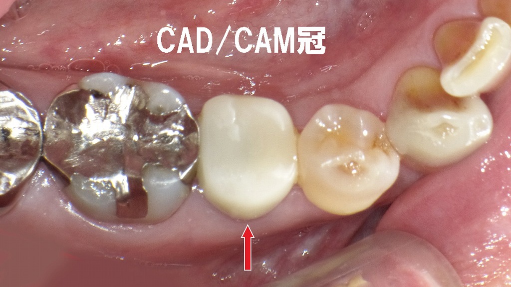 CAD/CAM冠:保険適用