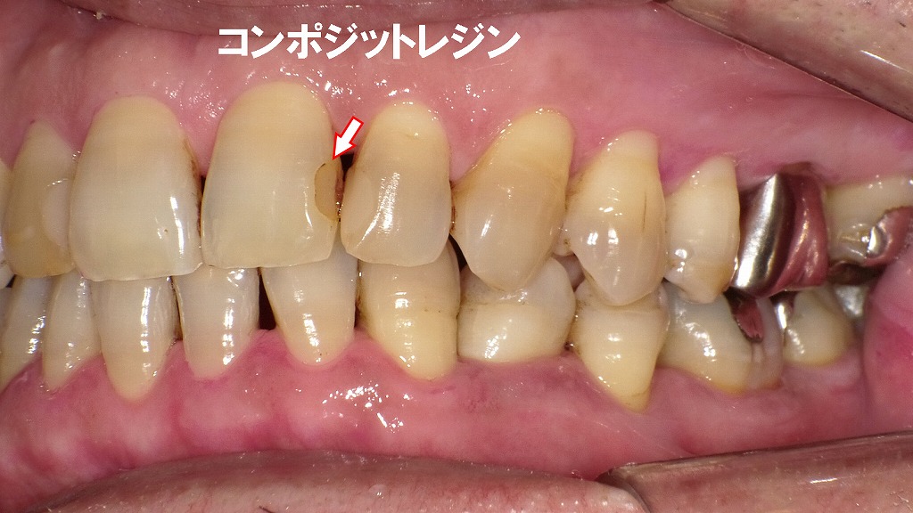 術後：ステイン除去症例