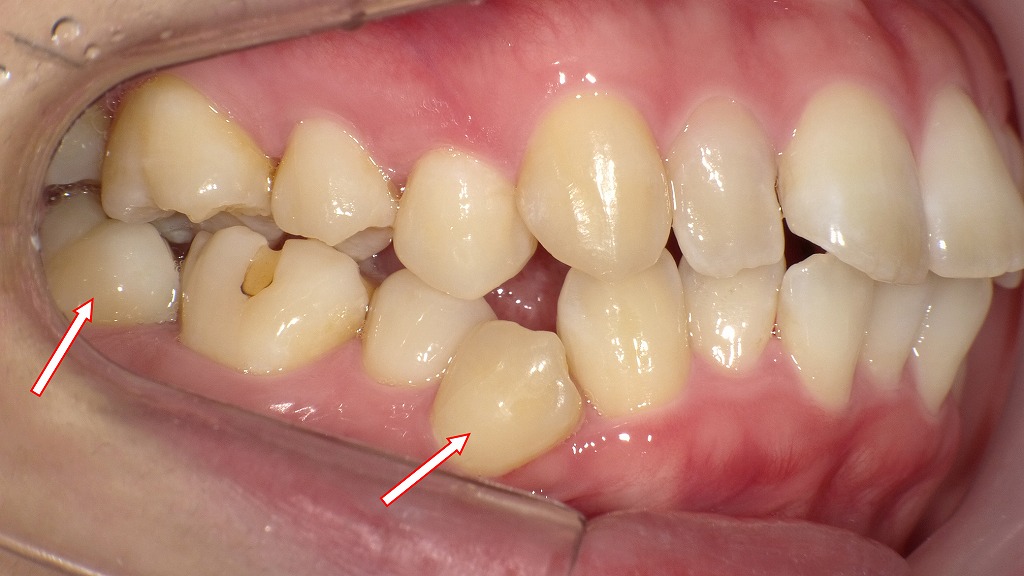 同症例の臼歯部の叢生の口腔内写真