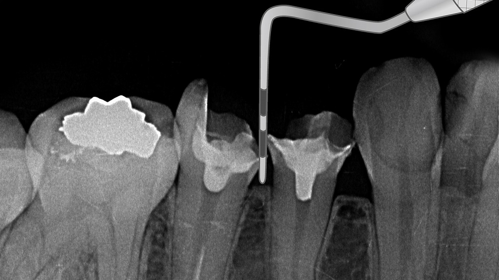 健全な歯周組織のプロービング所見