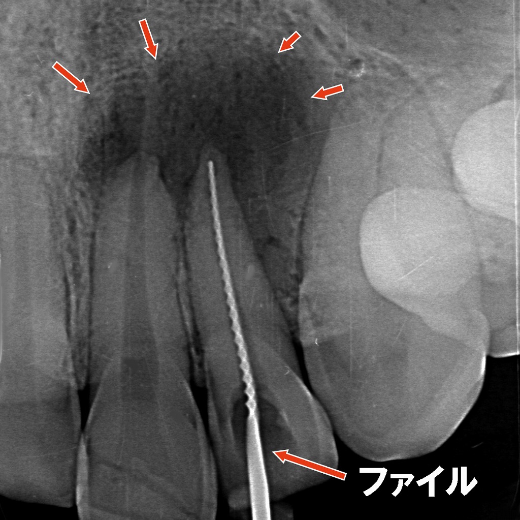 根管治療：根管長測定とファイル試適