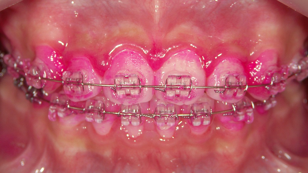 ワイヤー矯正中のプラークコントロール