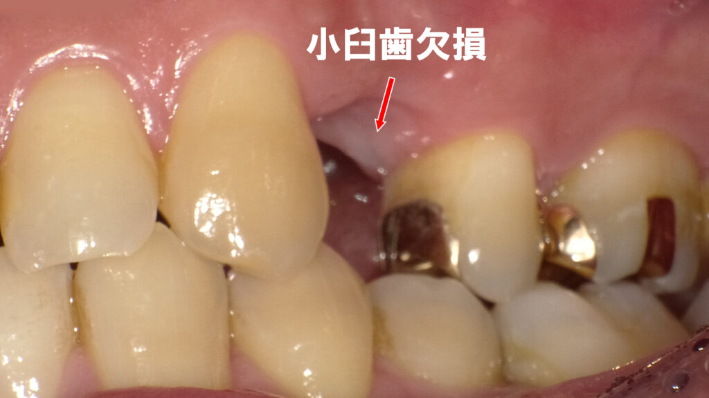 第一小臼歯欠損