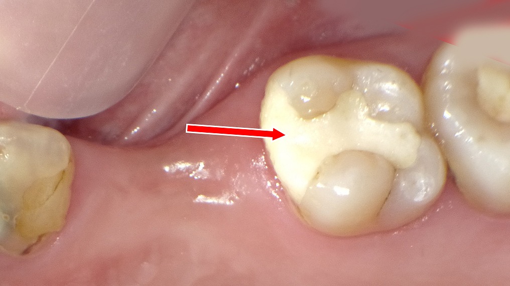 白い部分は次回まで歯を守るための仮詰めです。