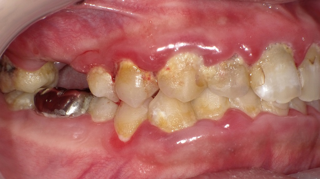 赤く腫れた歯ぐきと大量の歯垢・歯石が、歯が浮くような違和感を引き起こす典型例です。