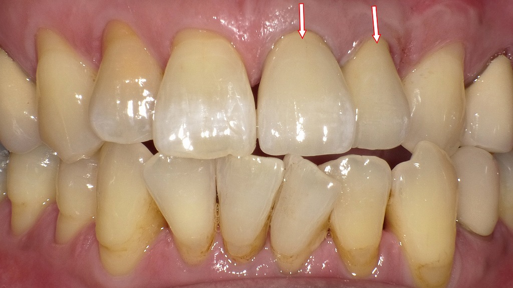 オールセラミッククラウンを装着