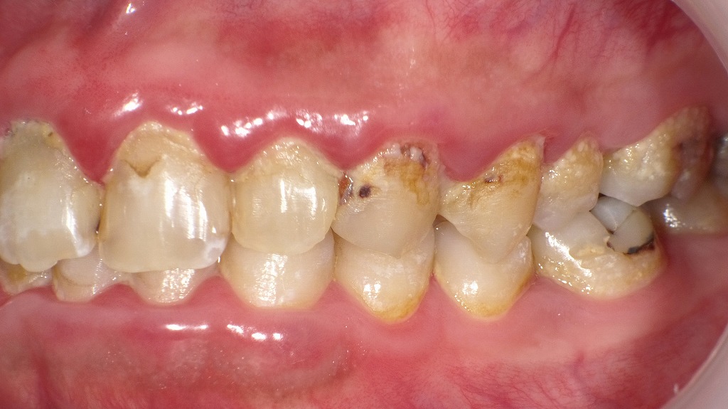 8020達成の大敵となる歯ぐきの炎症・虫歯・プラーク。早期ケアと定期検診で歯を守りましょう。