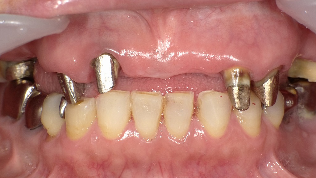 上顎ブリッジのための支台歯築造