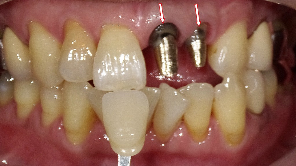 メタルコアによる支台築造とシェードテイキング