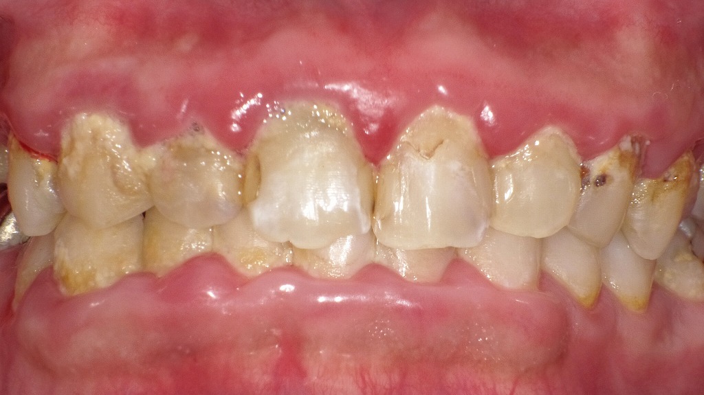 磨き残しが長期間続くと、歯周病菌が増殖し、歯ぐきの腫れ・出血・歯石沈着が進行します。