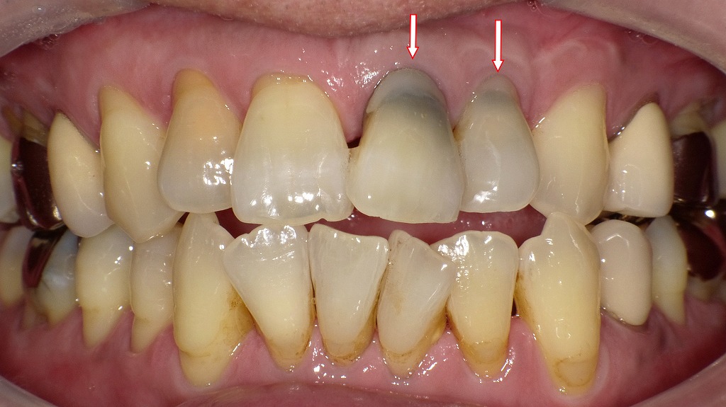 神経の死んだ歯の変色