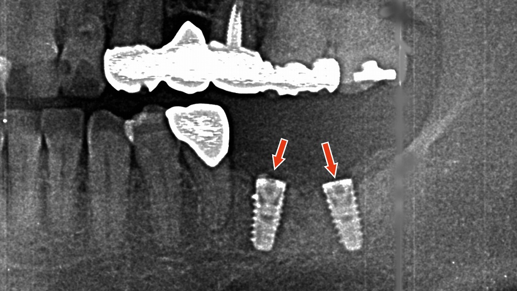 2枚目：埋入直後のパノラマレントゲン