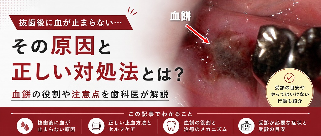 抜歯後に血が止まらないのはなぜ？