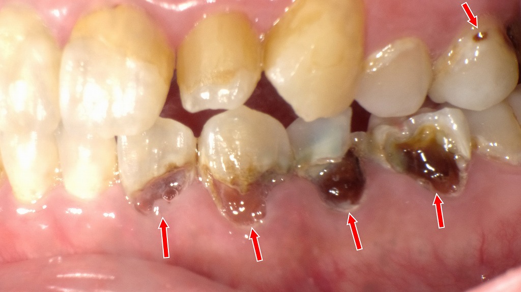 歯に残ったプラークが長期間作用すると、虫歯は深く広く広がります。