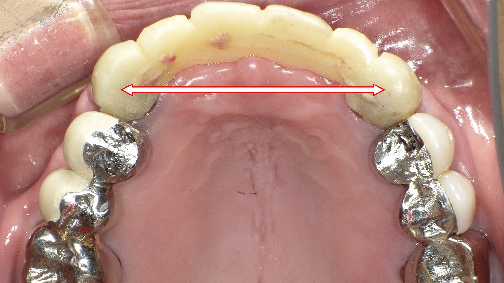 口蓋側：ブリッジ形態の仮歯