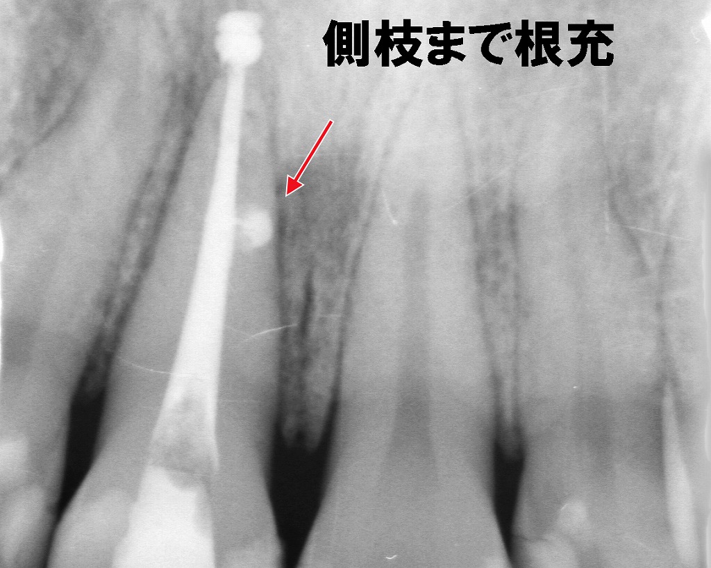 垂直加圧充填：側枝まで確実に封鎖する精密根管治療