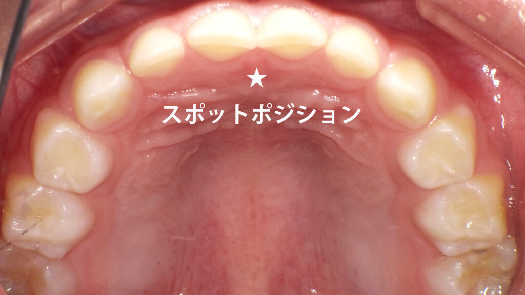 正しい舌の位置（スポットポジション）