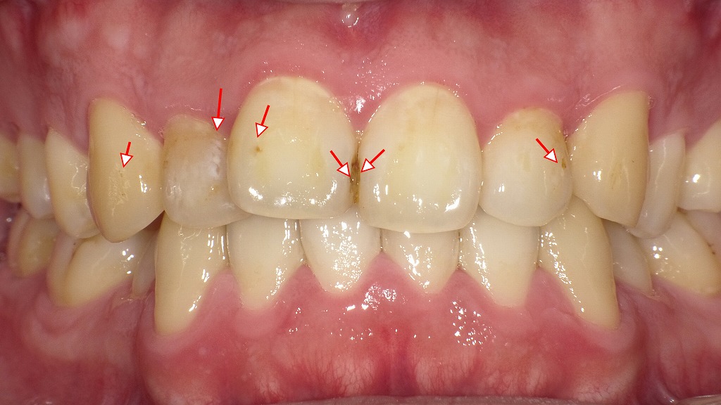 歯のザラザラ感のある口腔内写真
