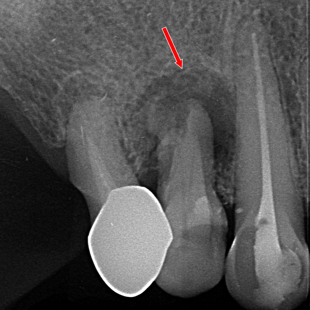 宇宙環境で悪化しやすい根尖病巣と歯根吸収