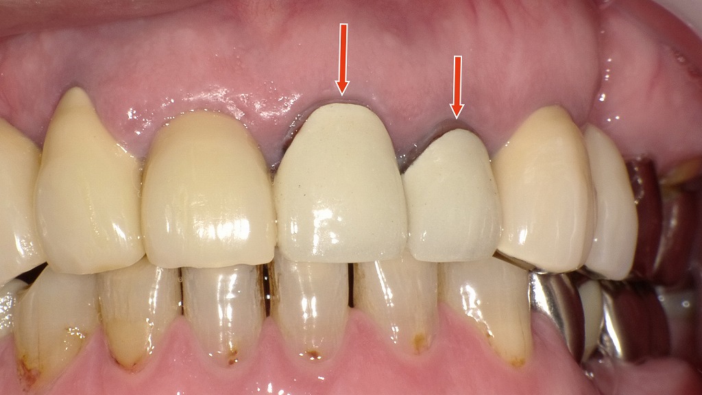 メタルボンド冠にブラックマージン