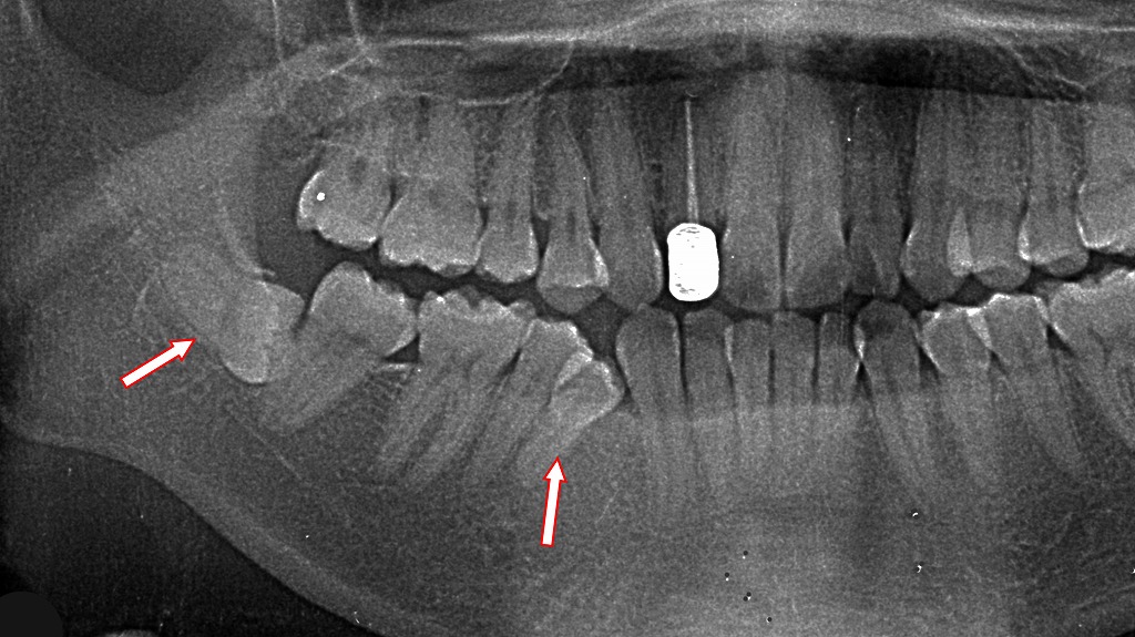 臼歯部の叢生のパノラマX線写真
