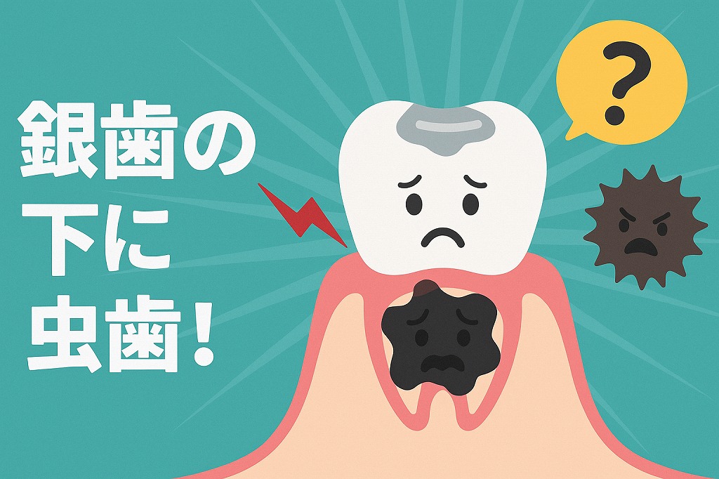 銀歯の下に虫歯ができる原因と症状