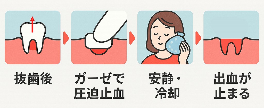 抜歯後の正しい止血方法