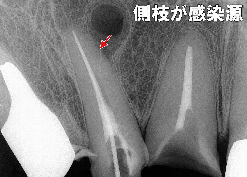 側枝感染が治癒を妨げる理由｜根管治療が難しくなる見えない通路