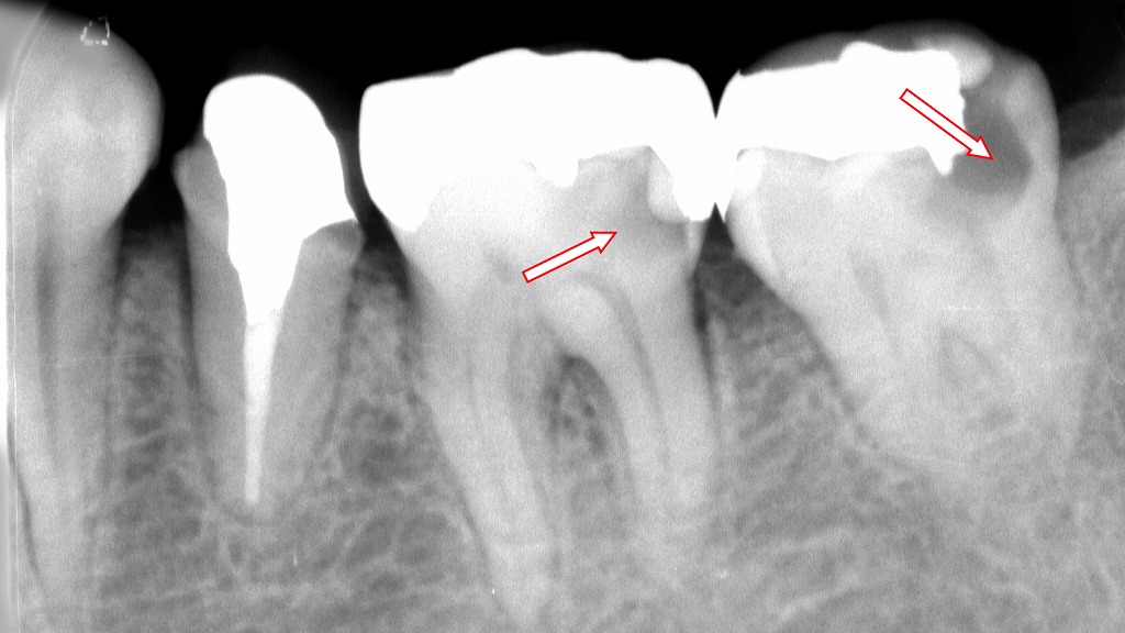症例2：インレー（詰め物）の下に虫歯