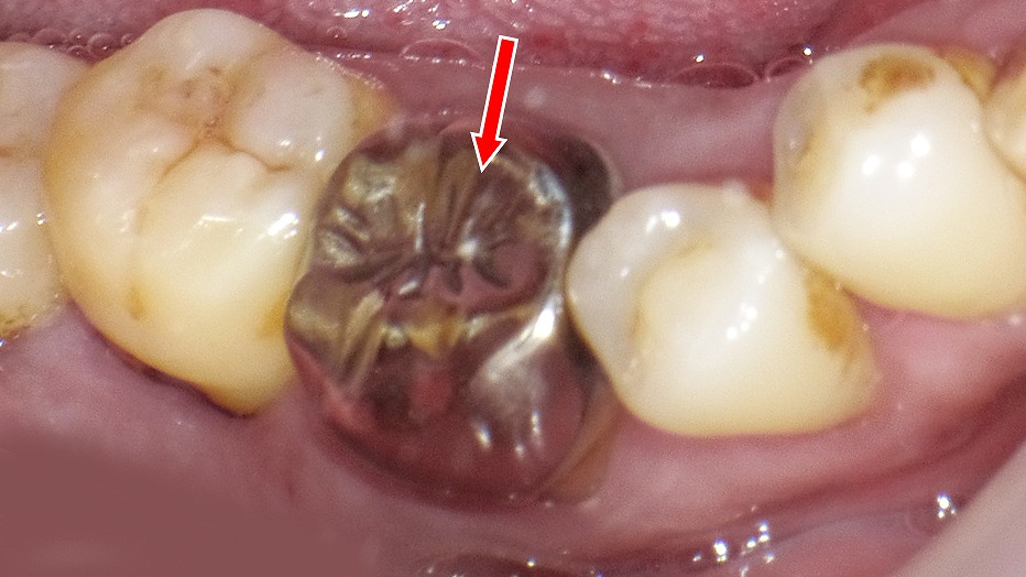 金銀パラジウム合金