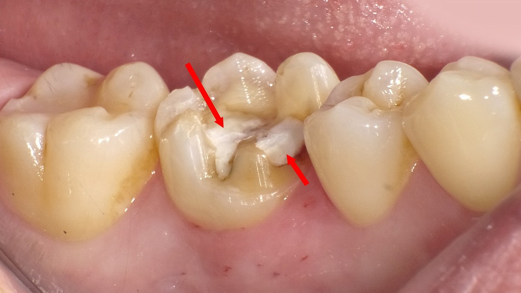 神経の保護(覆髄)
