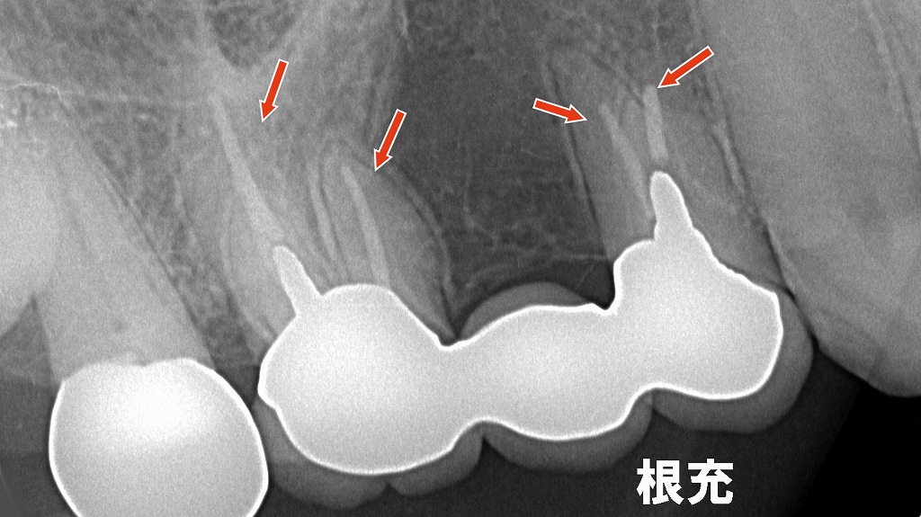 適切な根管充填