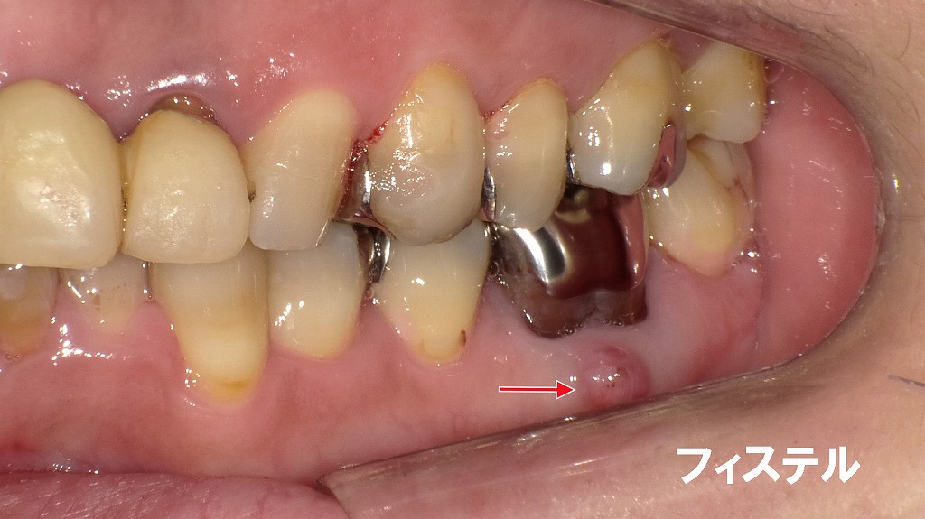 口の中に「水ぶくれ」ができる理由 ― 歯の根の感染が原因のフィステル